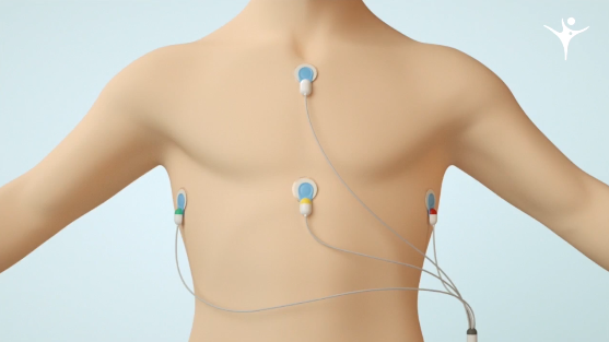 Attach the electrodes to four prominent points of the body